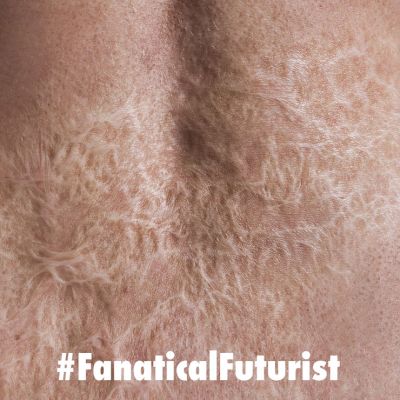 futurist_skin_burns